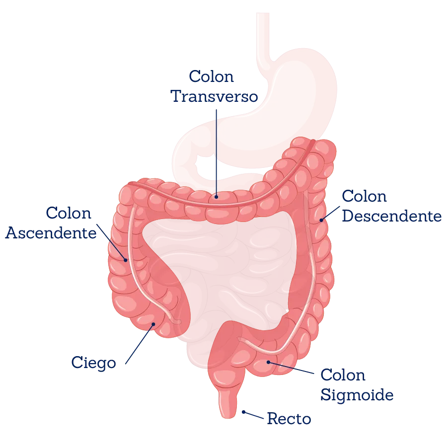 Ilustración médica del cáncer de colon y recto, mostrando la presencia de células cancerosas en el colon y/o el recto
