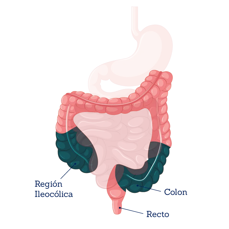 Ilustración médica de la enfermedad de Crohn afectando diversas partes del tracto gastrointestinal