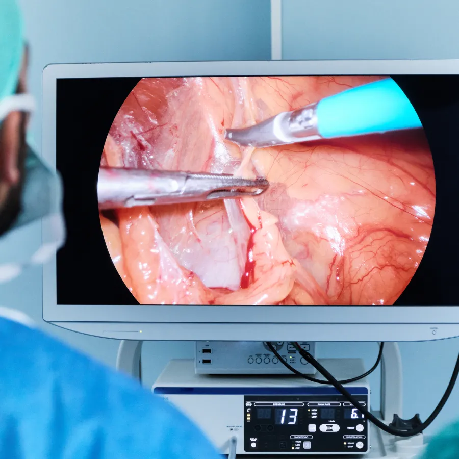 Imagen médica del Dr. Diego Marine realizando una cirugía laparoscópica, como se ve en un monitor.