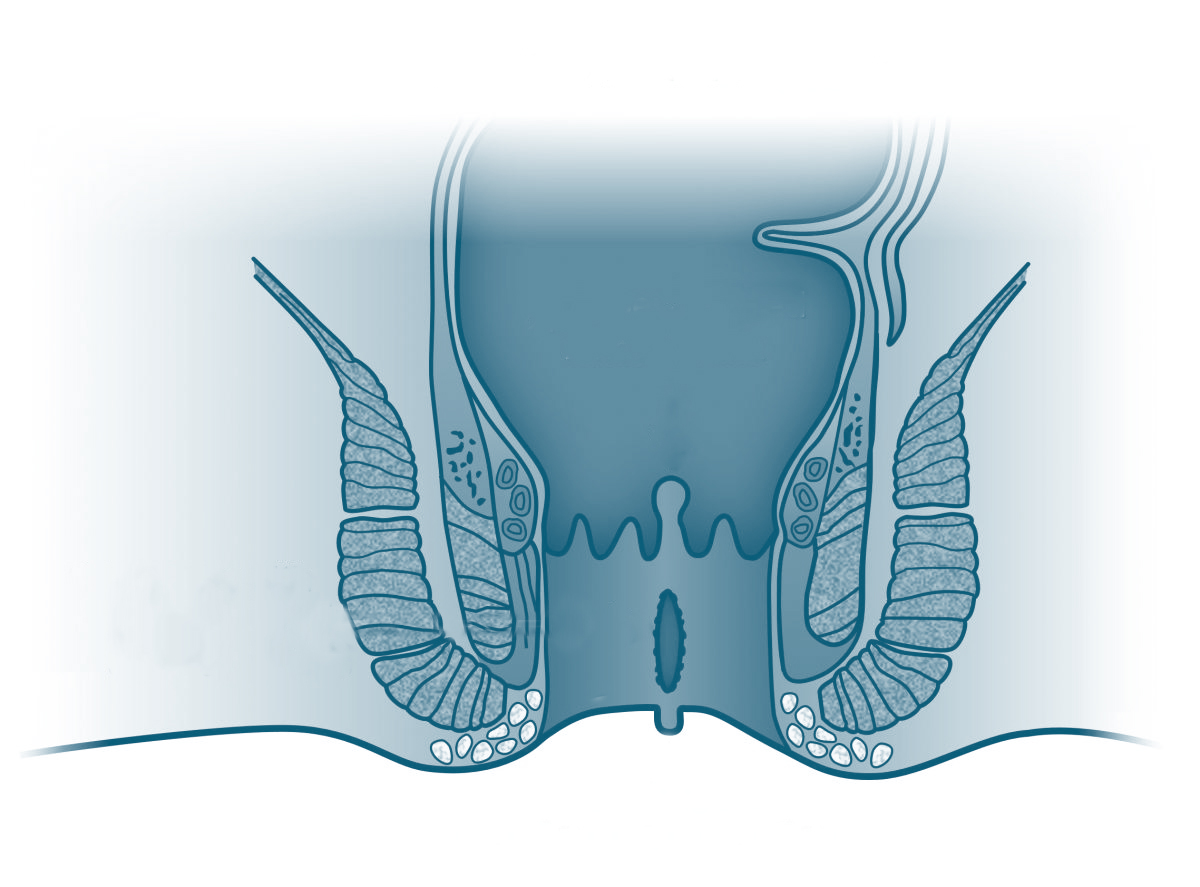 Ilustraci&oacute;n de una fisura anal mostrando la ubicaci&oacute;n y el desgarro en el tejido anal, con una descripci&oacute;n de los tratamientos disponibles.